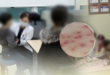 제주, 수두 발생률 전국 평균의 4배 … 집중관리 감염병 지정