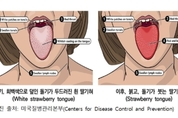 '딸기혀'에 격리까지 … 제주 어린이 성홍열 급증